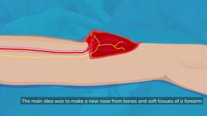 In World First, Ljubljana Hospital Grows New Nose on Patient’s Forearm (Video)