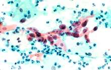 Squamous cell carcinoma in the cervix, pap stain